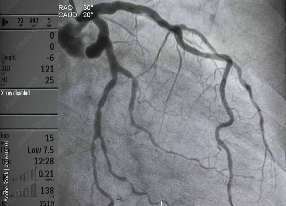 What Is an Coronary Angiogram