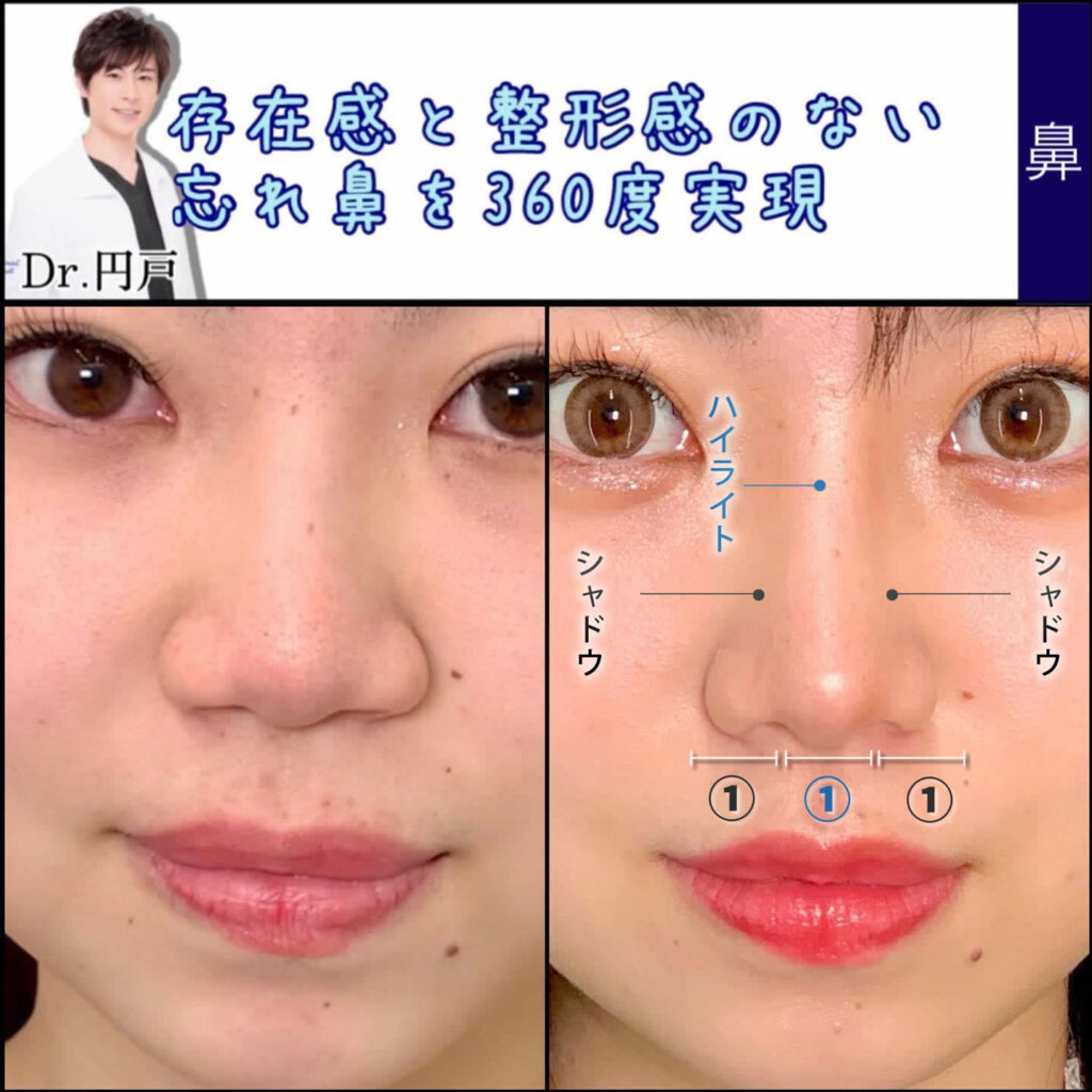 鼻の形変える最新美容医療術！自力ケアの限界と理想のEライン獲得法