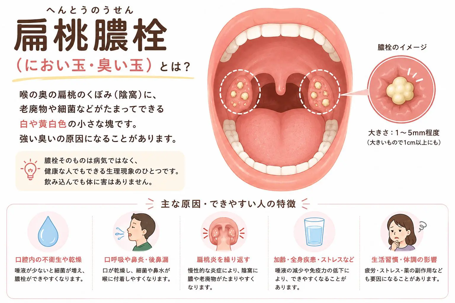 2026年、なぜ喉の奥の「小さな白い塊」にSnsと耳鼻咽喉科が揺れているのか——正体と危険なNgケア、最新治療のリアル