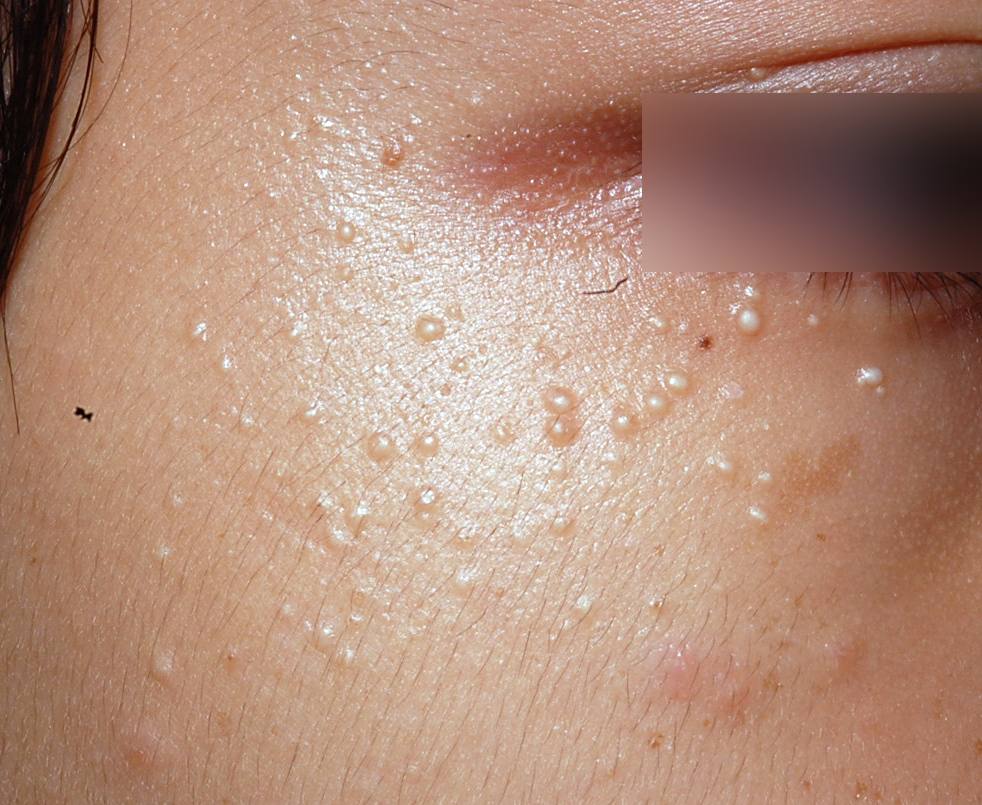 目の周りの白い粒は稗粒腫？写真で見る違いと皮膚科の最新治療【2026】