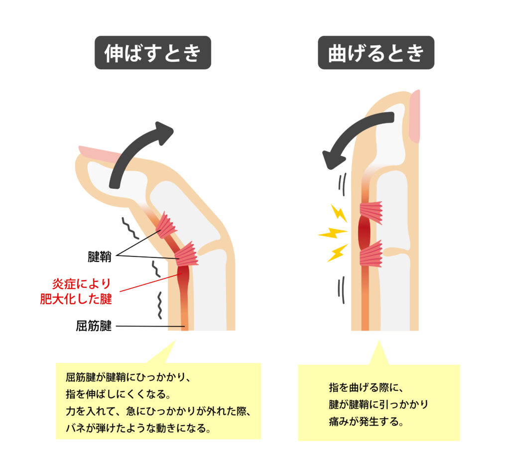 ばね指の原因は糖尿病？高血糖で指が引っかかる理由と2026年最新治療