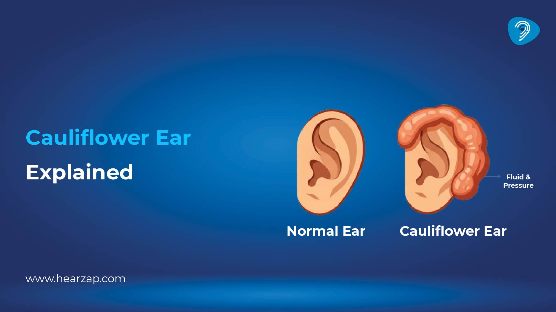 How Long Does Cauliflower Ear Last