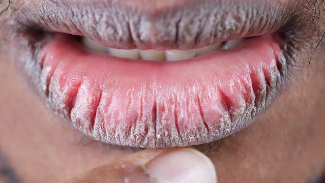 Why Is My Lips So Dry