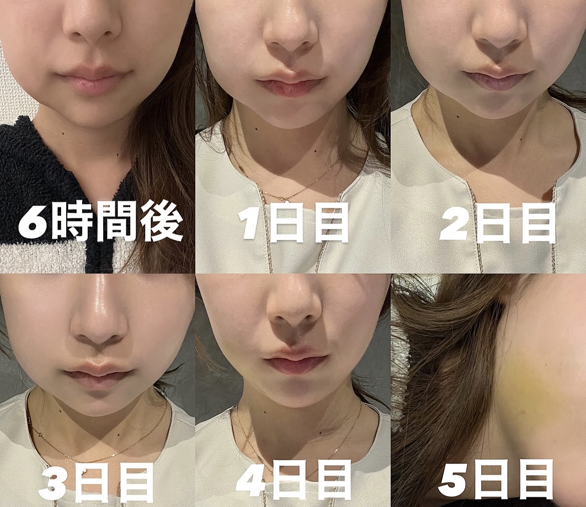 親知らず抜歯後の顔の腫れはいつ引く？ピーク時期と即効ケア法