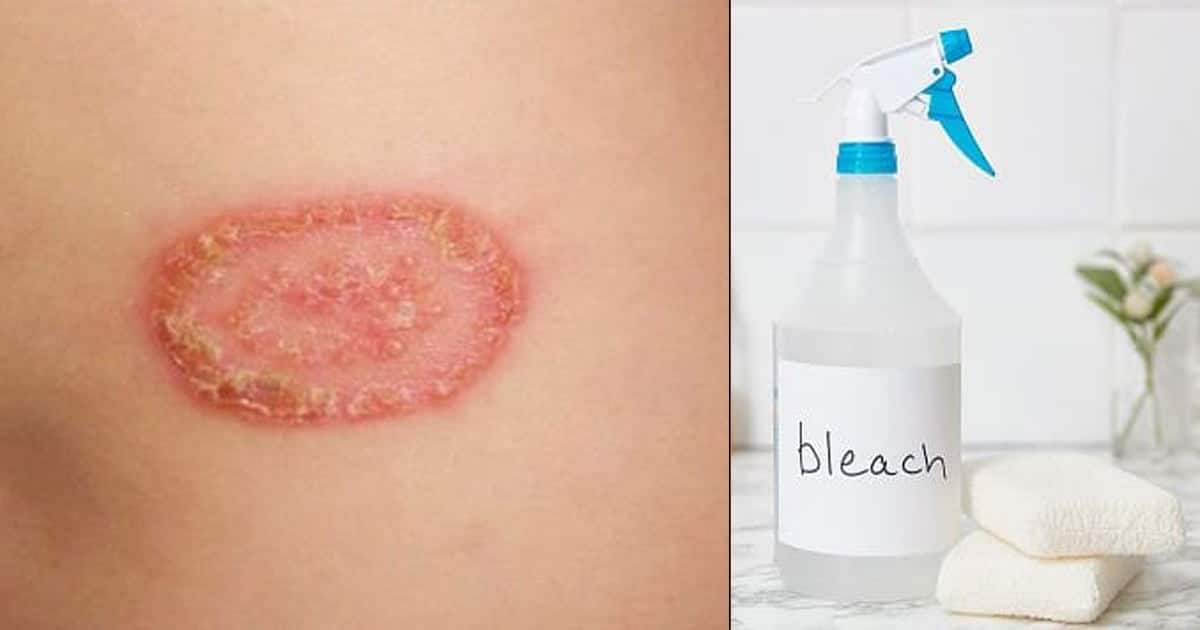 Treat Ringworm with Bleach