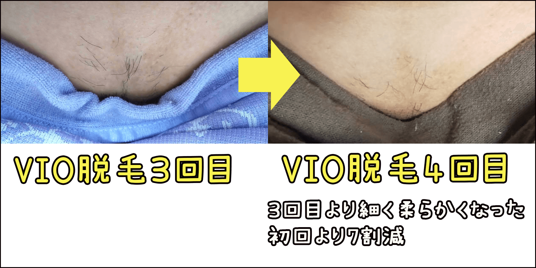 医療脱毛Vio経過写真の真実！抜ける日数と何回でツルツルか徹底検証