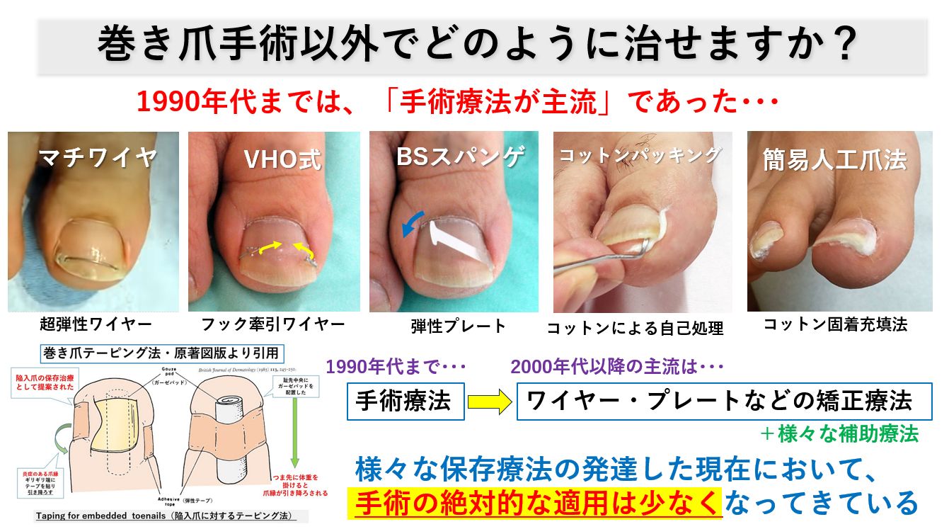 陥入爪手術のリアル体験談！麻酔の激痛や歩けない噂の真相と費用を徹底検証