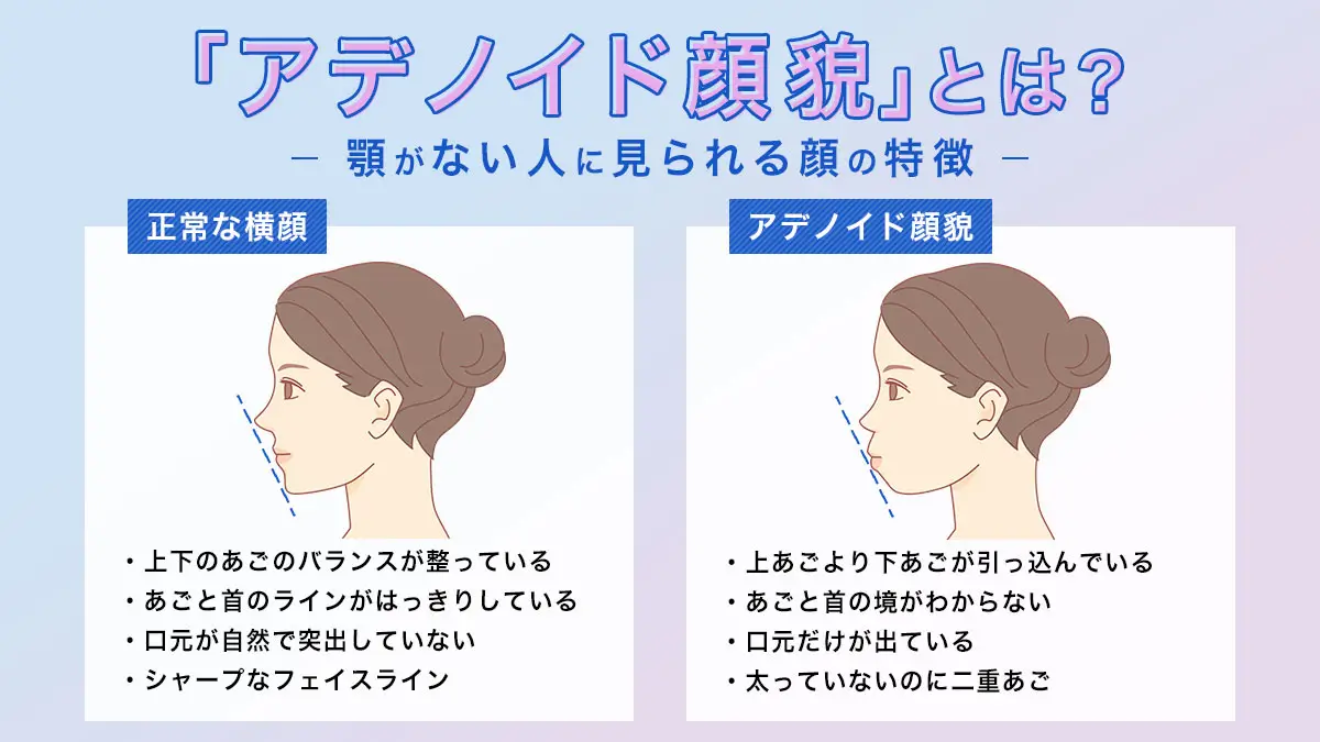横顔の「顎がない」は治せる？アデノイド顔貌の原因と大人の最新治療
