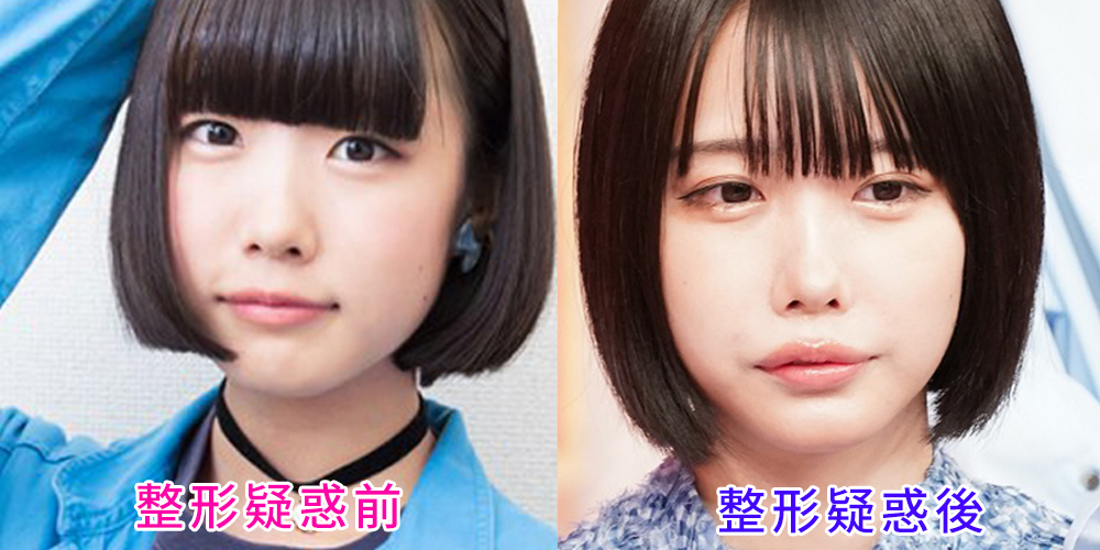 あのちゃんの「整形前」噂に真相はあるのか？過去写真のギャップと2026年現在の素顔