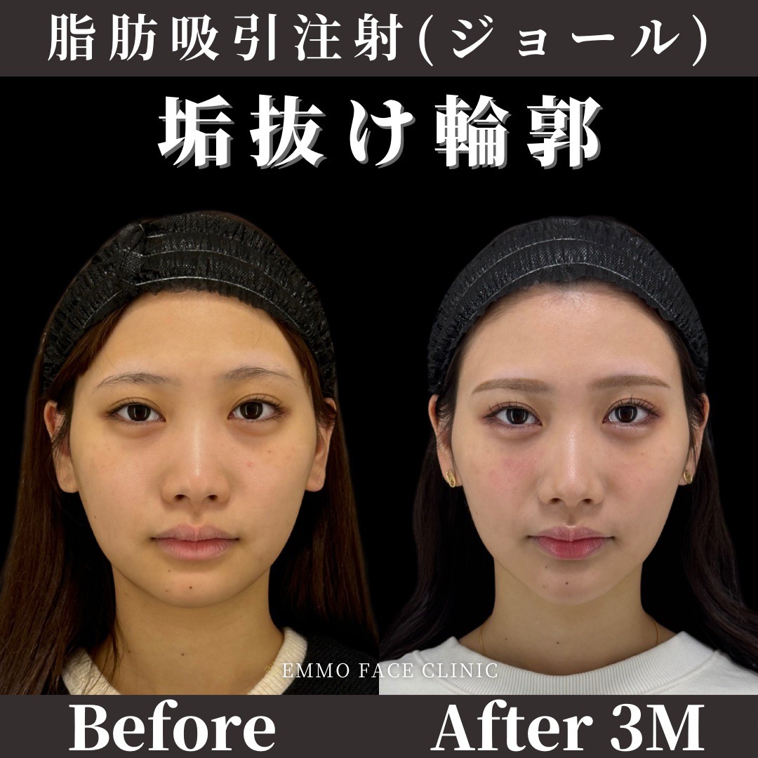 頬の肉を落とす決定打！落ちない理由と2026年最新小顔アプローチ