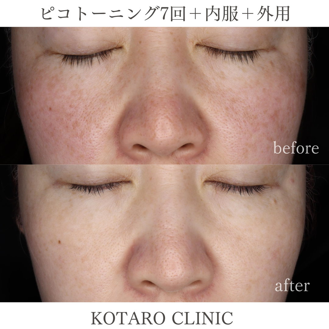 ピコトーニングとは？シミ・肝斑改善の効果や従来機との違いを徹底解剖