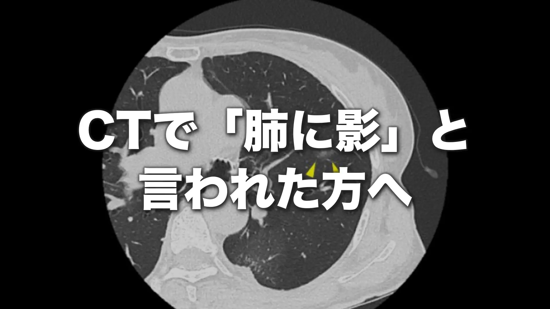 健診で肺に影があると言われたら？がんの確率と精密検査の真実