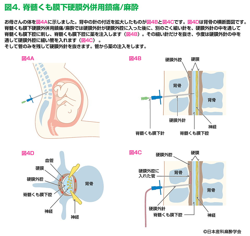 麻酔の後遺症はいつ治る？しびれ・頭痛の正体と今すぐできる対処法