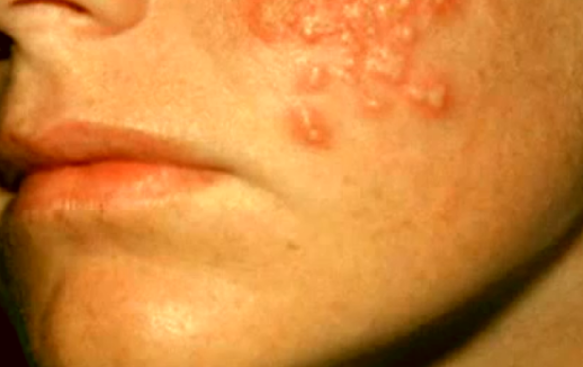 Early Stage Hiv on Face