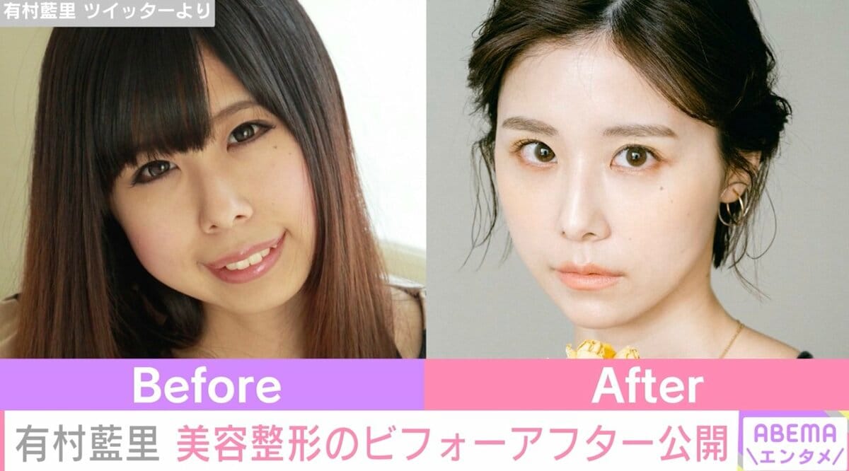 有村藍里が整形を決意した真意とは？骨切り手術の全貌と劇的変化