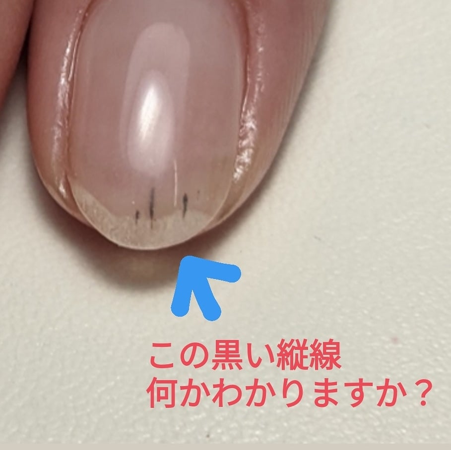 爪の真ん中に突如現れた黒い縦線、単なる色素沈着か皮膚がんか