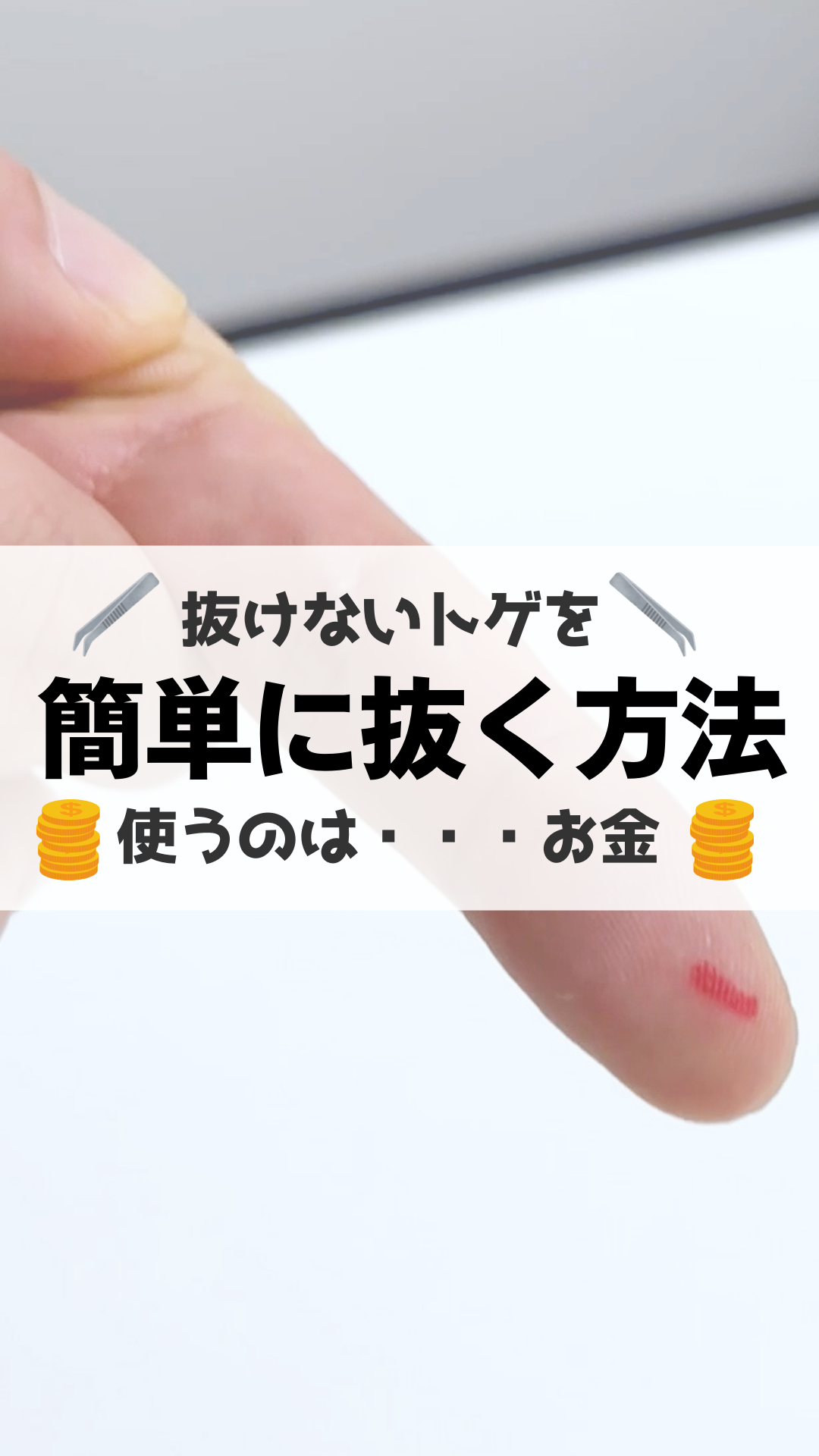指のトゲが抜けない時の対処法と痛くない抜き方・受診目安を解説