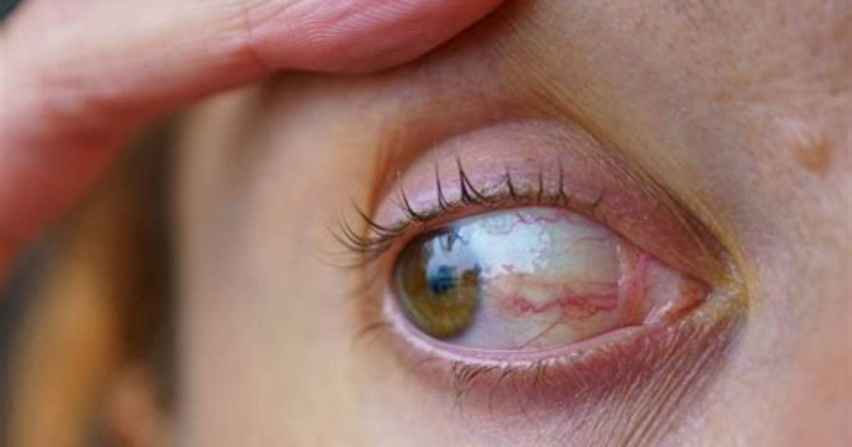 Eye Condition